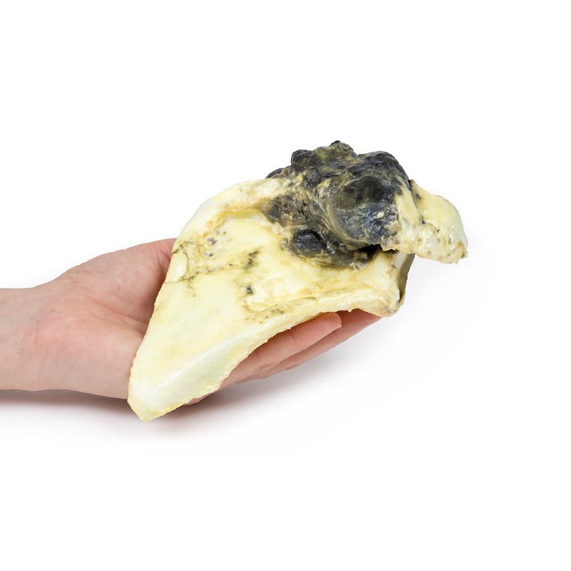 3D Printed Chondrosarcoma of Scapula