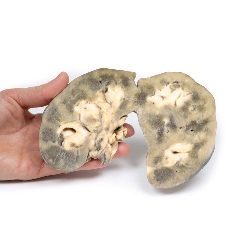3D Printed Horseshoe Kidney