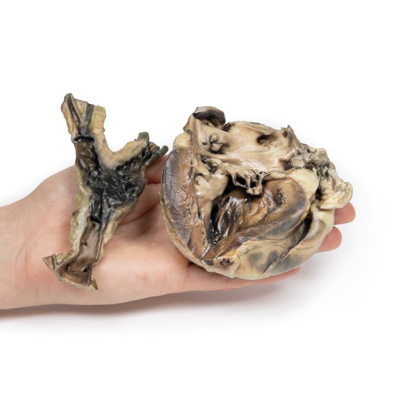3D Printed Hydatid Disease Affecting the Heart and Aorta