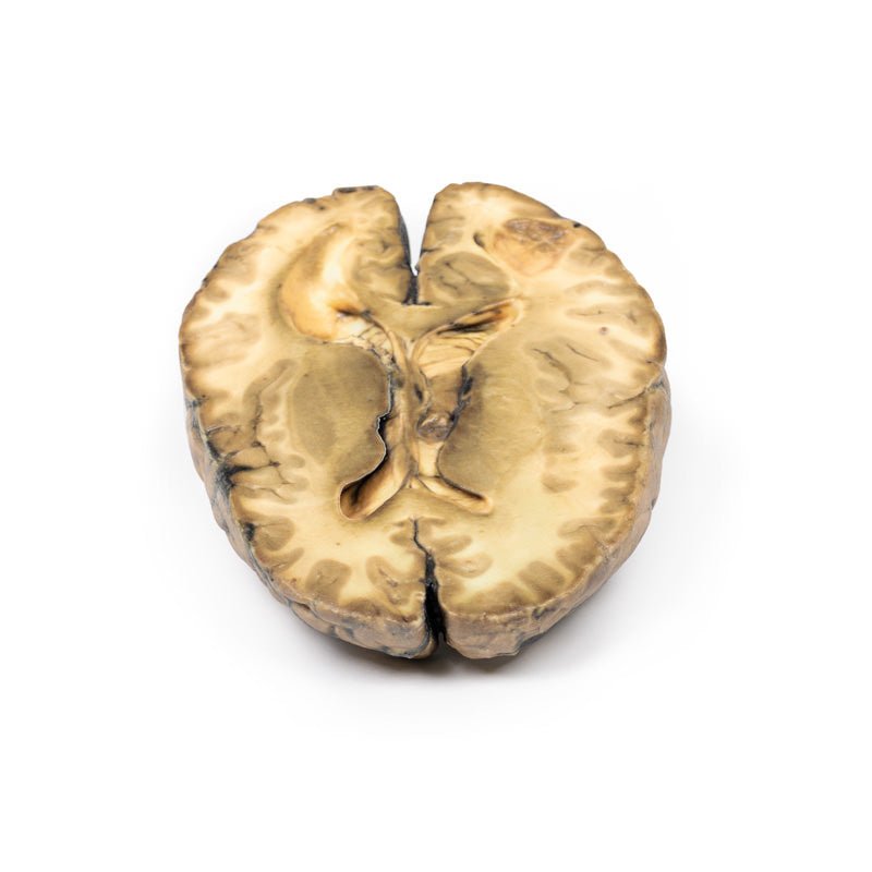 3D Printed Metastatic Carcinoma in the Brain