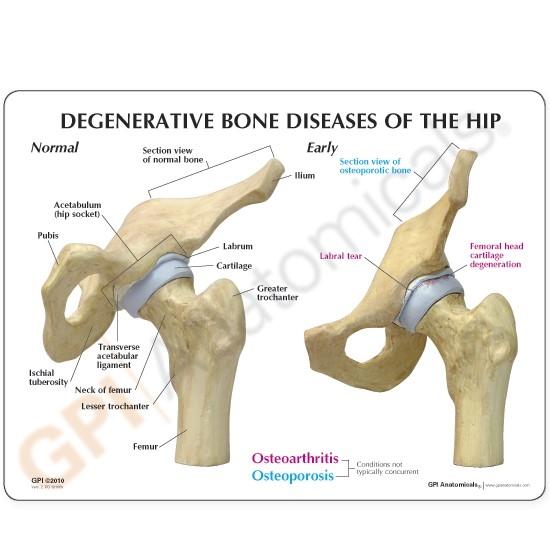 4-Stage Degenerative Hip Bone Diseases