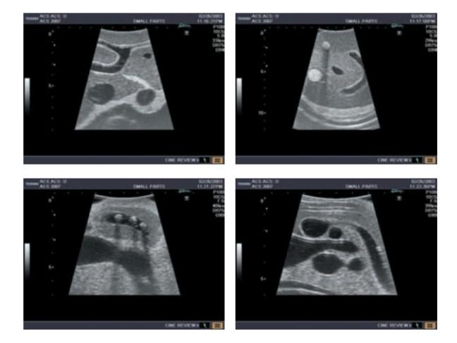 Abdominal Intraoperative and Laparoscopic Ultrasound - IOUSFAN
