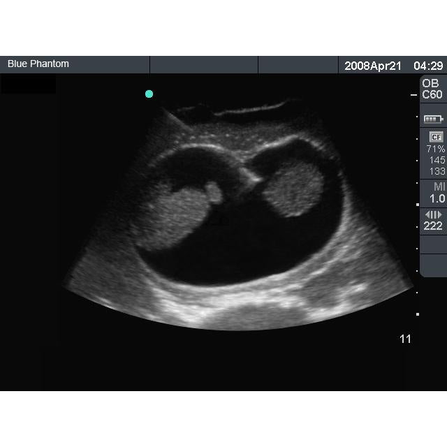 Amniocentesis Ultrasound Training Model