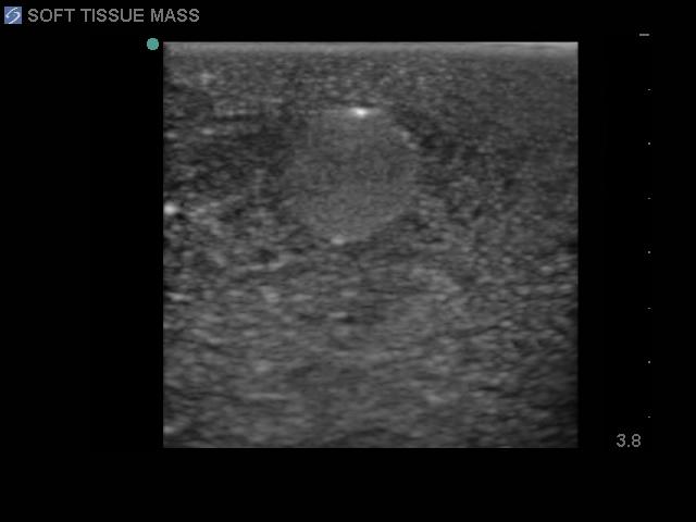Breast Biopsy Ultrasound Training Model