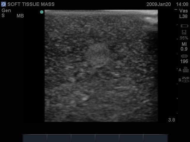 Breast Biopsy Ultrasound Training Model