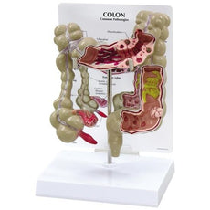 Colon Model with pathologies