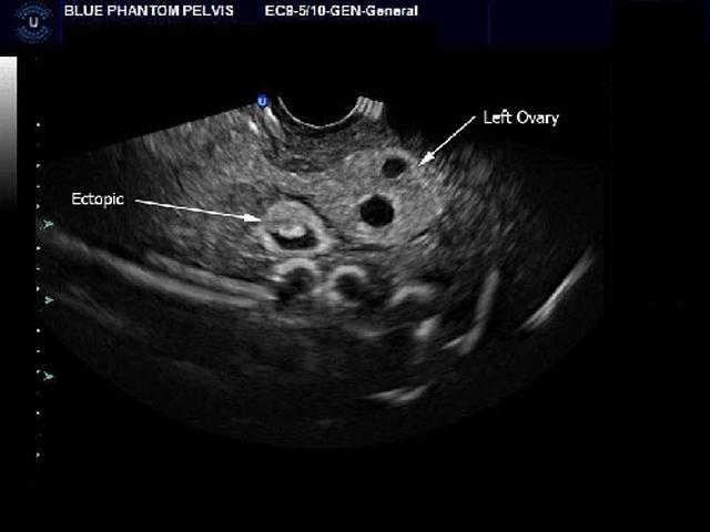 Combination IUP Ectopic Pregnancy Transvaginal Ultrasound Training Model