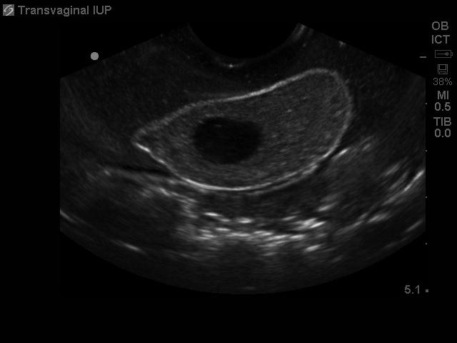 Combination IUP Ectopic Pregnancy Transvaginal Ultrasound Training Model