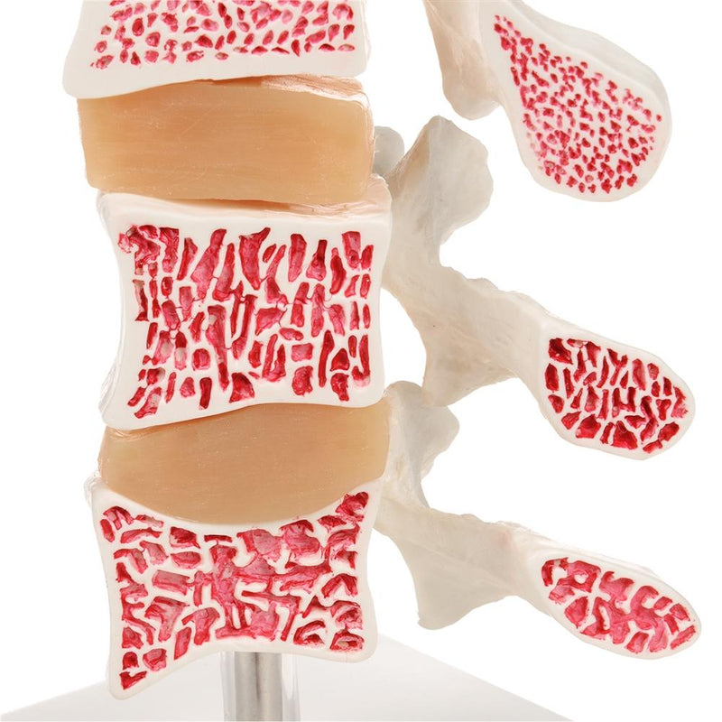 Deluxe Osteoporosis Model