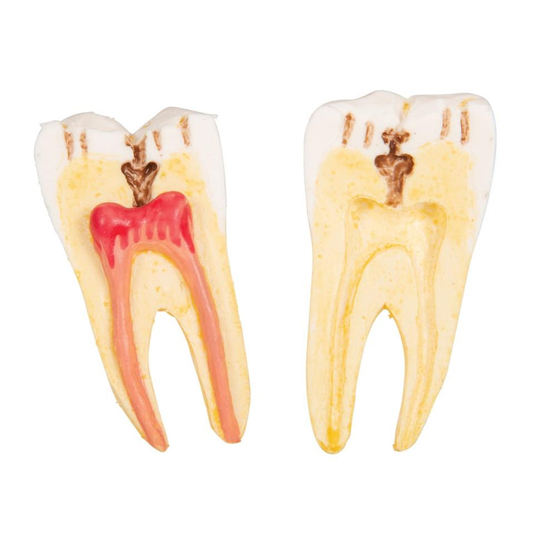 Dental Disease Model, 2x magnified, 21 parts