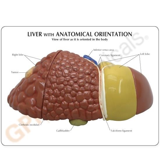 Diseased Liver (Cancer) Anatomy Model