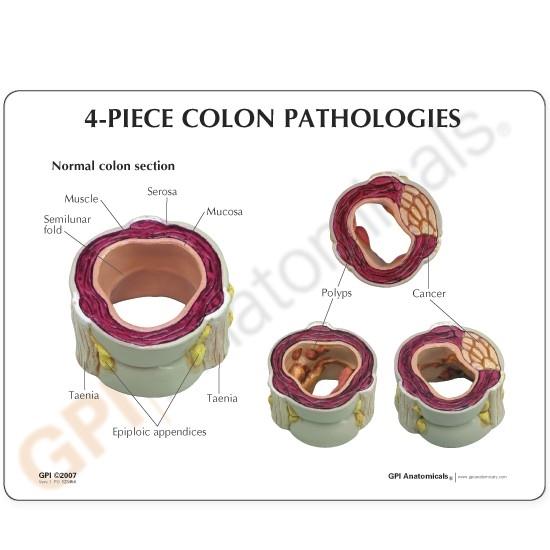 Four Piece Colon Model with Pathologies