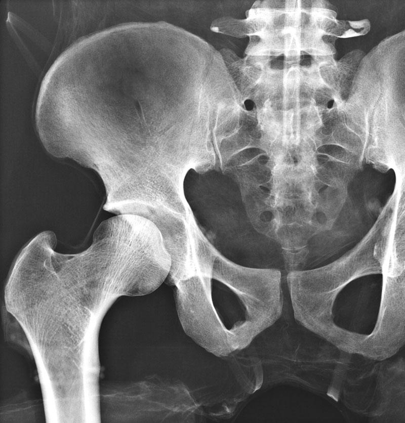 Full Body X-Ray Phantom with Real Human Skeleton Bones