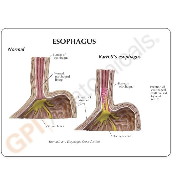 GastroEsophageal Reflux Disease Model (GERD)