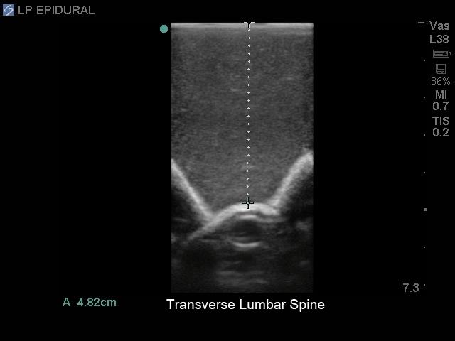Lumbar Puncture and Spinal Epidural Training Model