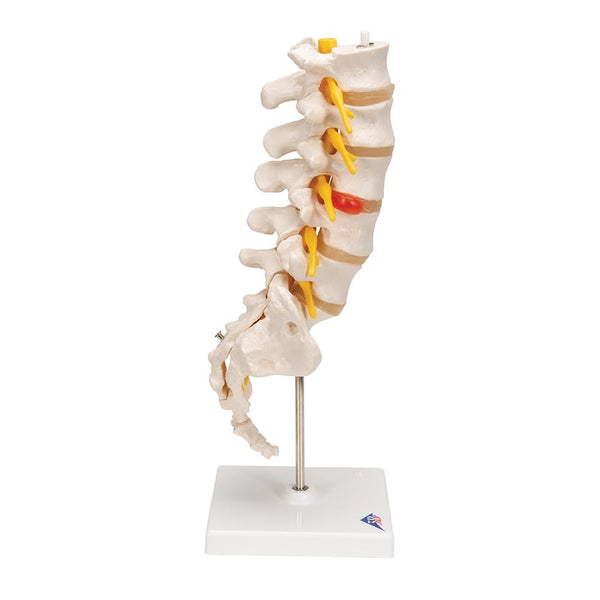 Lumbar Spinal Column with Dorso-lateral Prolapsed Intervertebral