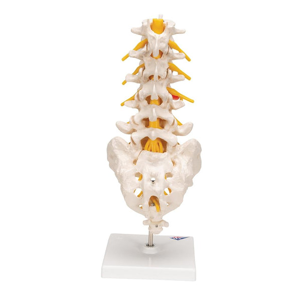 Lumbar Spinal Column with Dorso-lateral Prolapsed Intervertebral