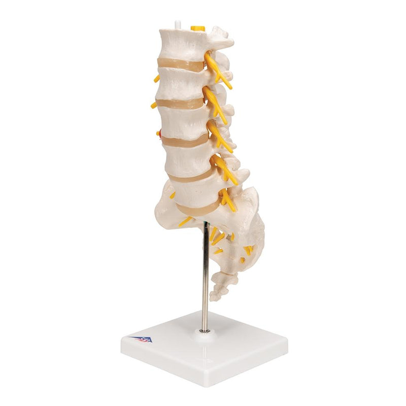 Lumbar Spinal Column with Dorso-lateral Prolapsed Intervertebral Disc