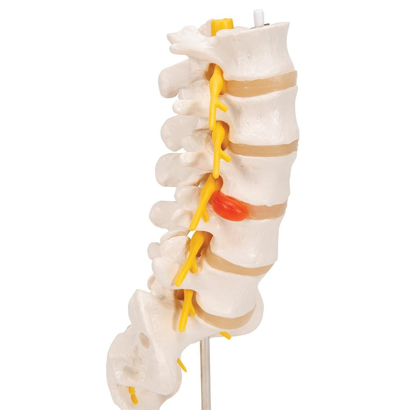 Lumbar Spinal Column with Dorso-lateral Prolapsed Intervertebral Disc