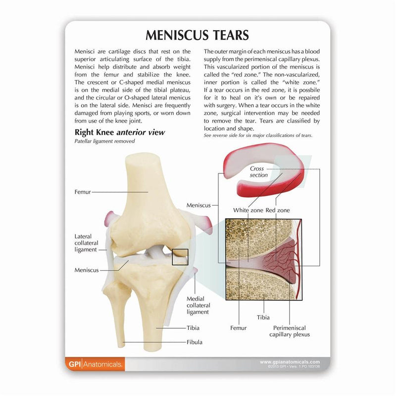 Meniscus Tears Model