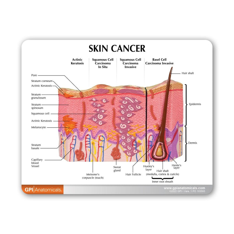 Skin Cancer Model