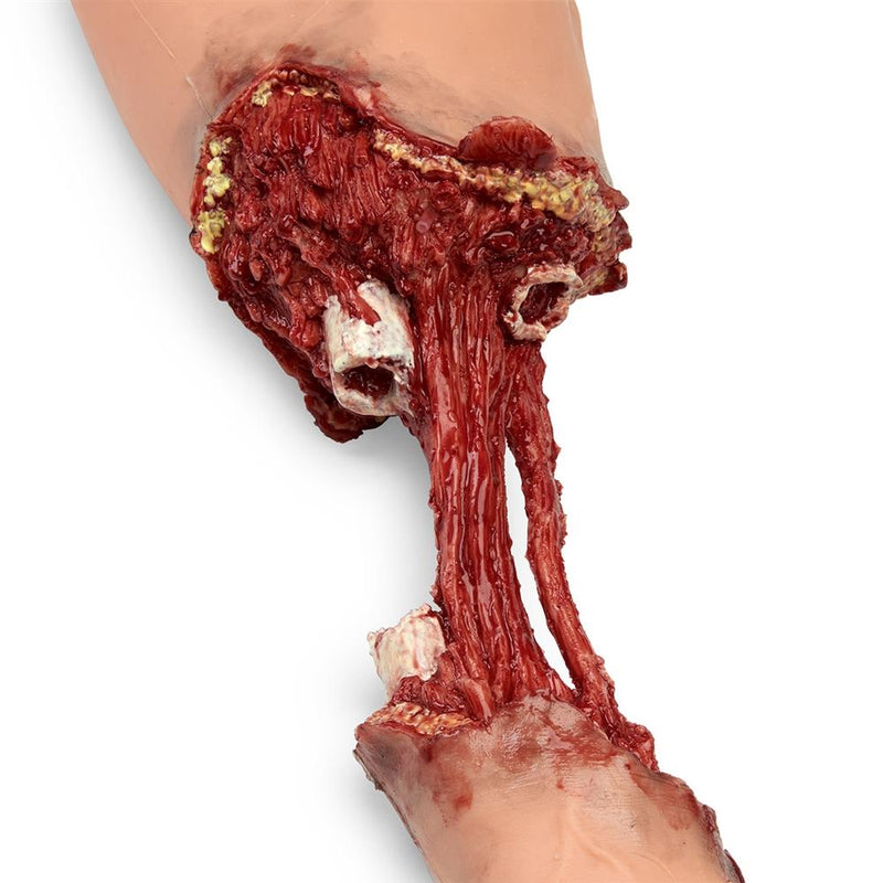 Trauma Bleeding Arm for Advanced SMART STAT