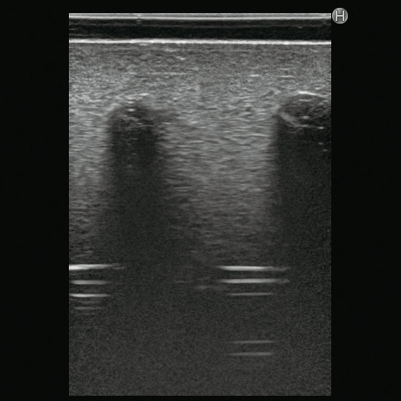 Ultrasound Lumbar Puncture Simulator