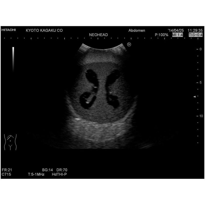 Ultrasound Neonatal Head Phantom, Abnormal Type