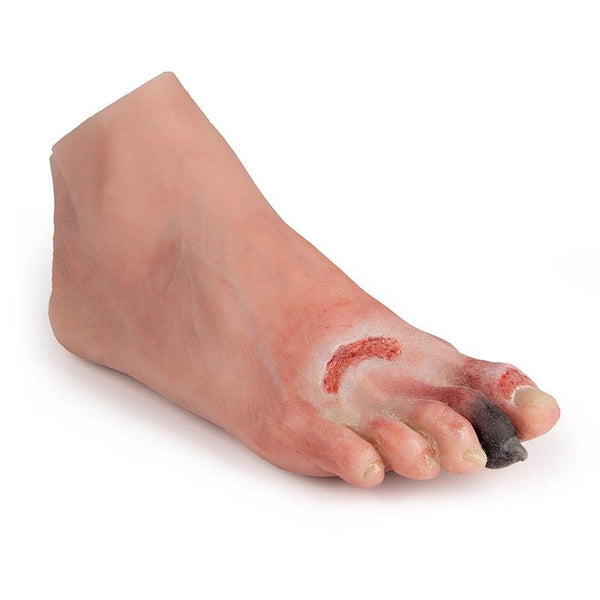 Wound Foot With Diabetic Foot Syndrome –