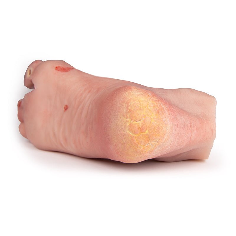 Wound Foot with Diabetic Foot Syndrome, Severe Stage