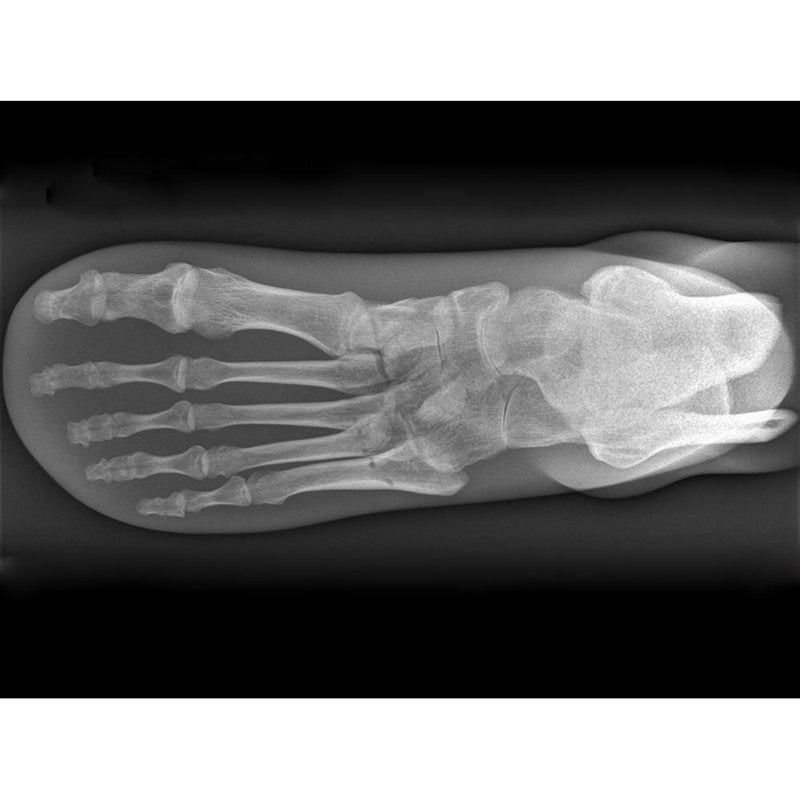 X-Ray Phantom Foot, Transparent