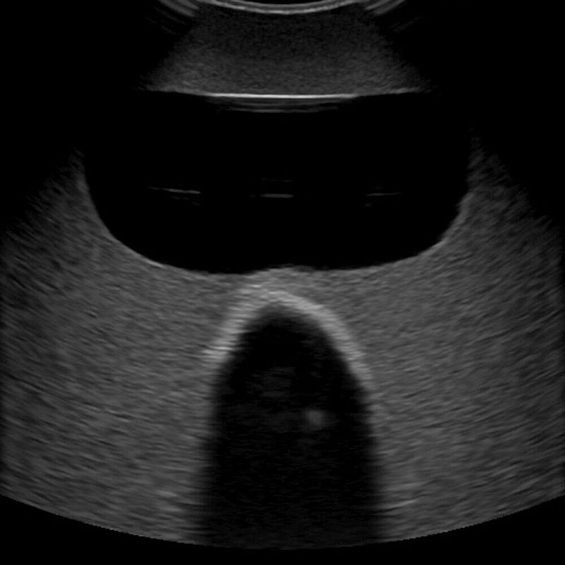 Rectal and Bladder Ultrasound Phantom