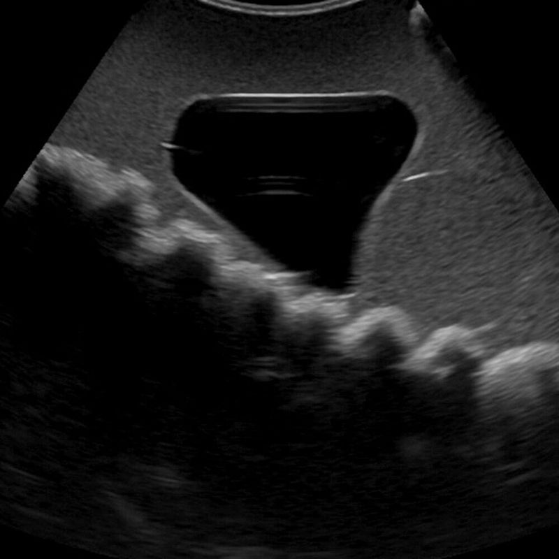 Rectal and Bladder Ultrasound Phantom