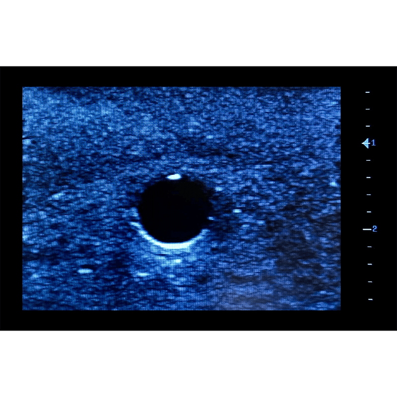 Femoral Access Ultrasound Simulator with Aneurysms