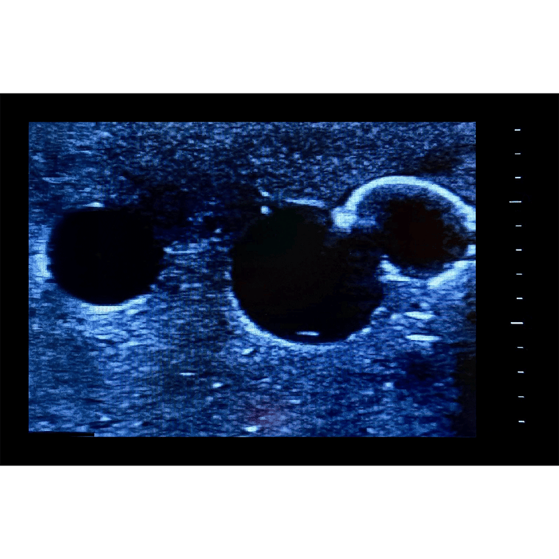 Femoral Access Ultrasound Simulator with Aneurysms