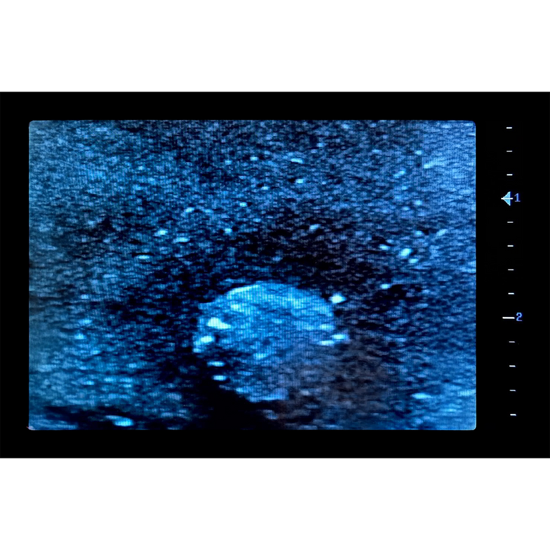 Ultrasound Simulator with Breast Pathologies/Biopsy