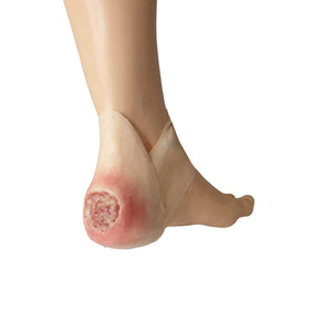 Bedsore On Heel