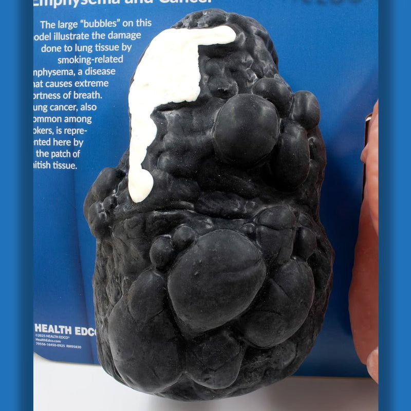 Breathless Brian™ Smoker’s Lungs Comparison Model