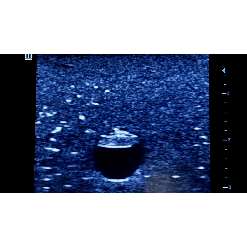 Central Access Ultrasound Simulator with Calcifications