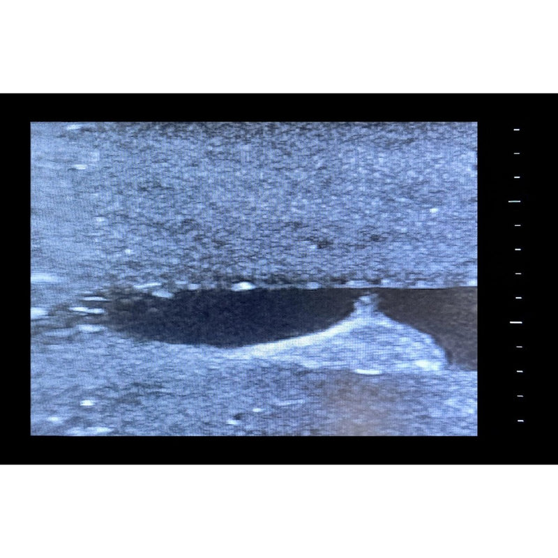 Central Access Ultrasound Simulator with Calcifications
