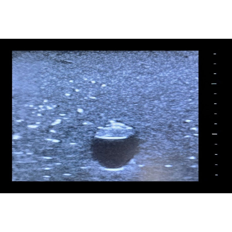 Central Access Ultrasound Simulator with Calcifications