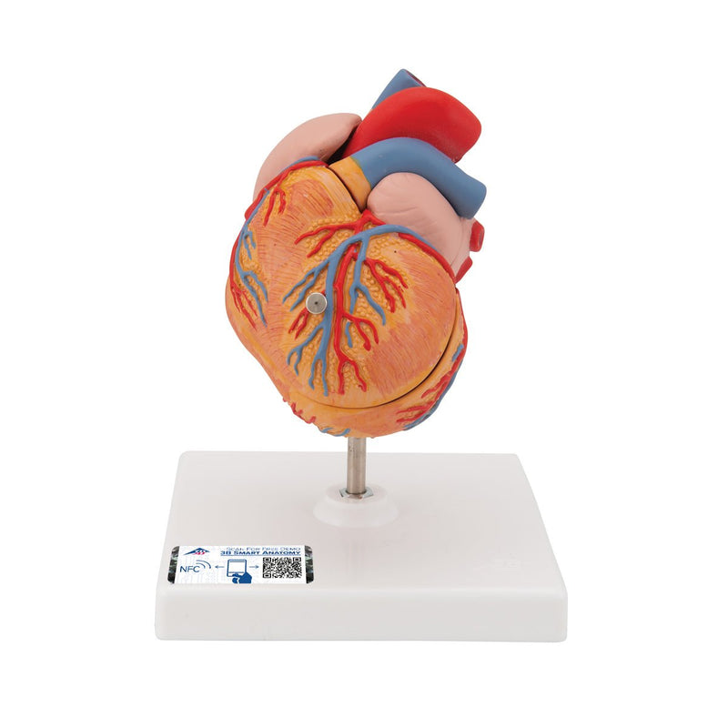 Classic Heart Model with Left Ventricular Hypertrophy (LVH), 2 part