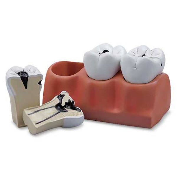 Dental Morphology Model, 4X Enlarged, 7 Parts