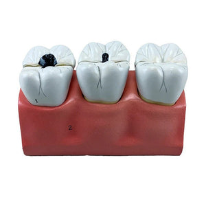 Dental Morphology Model, 4X Enlarged, 7 Parts