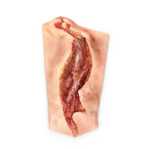 Electrical Burn Lower Arm