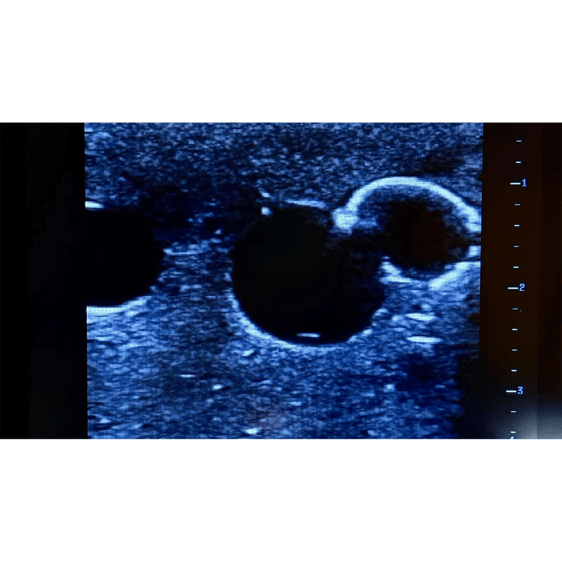 Femoral Access Ultrasound Simulator with Aneurysms