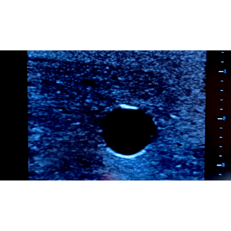 Femoral Access Ultrasound Simulator with Aneurysms
