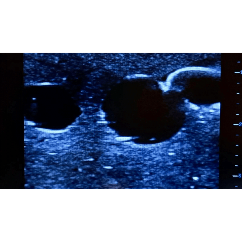 Femoral Access Ultrasound Simulator with Aneurysms