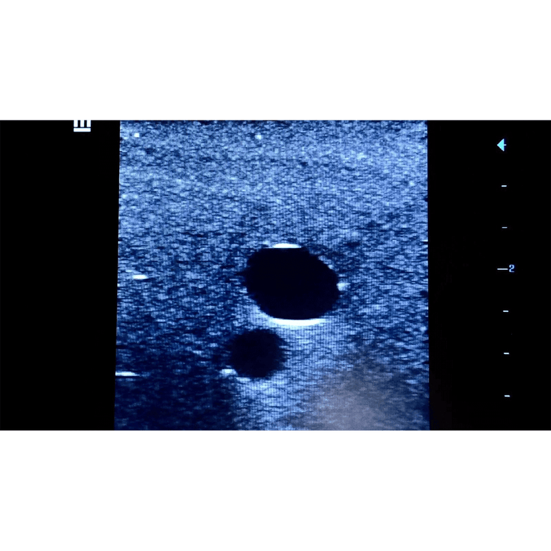 Femoral Access Ultrasound Simulator with Calcifications