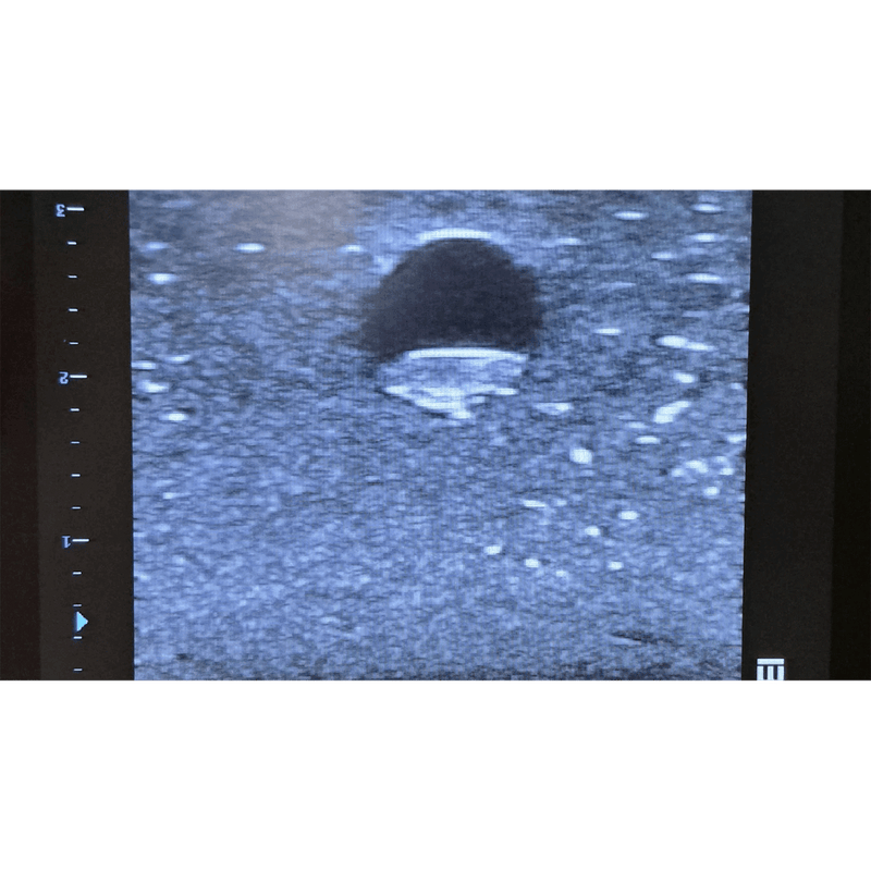 Femoral Access Ultrasound Simulator with Calcifications